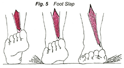 Att tibialis anterior  inte orkar hålla totvalvet uppe vid benhinneinflammation är vanligt.